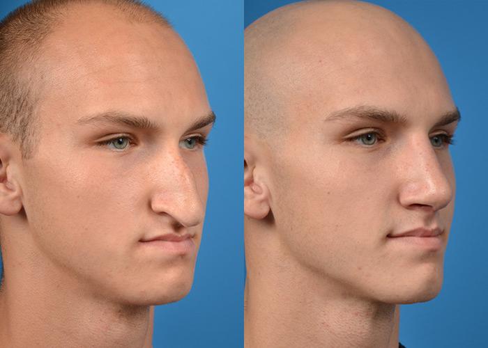 Male Rhinoplasty Melbourne, FL Patient 11244